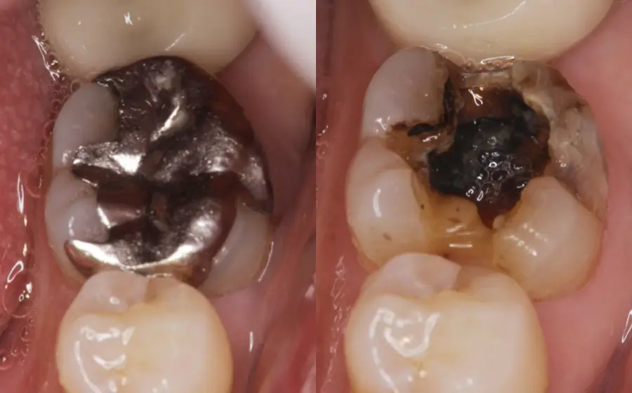 写真：金属を用いた治療による虫歯